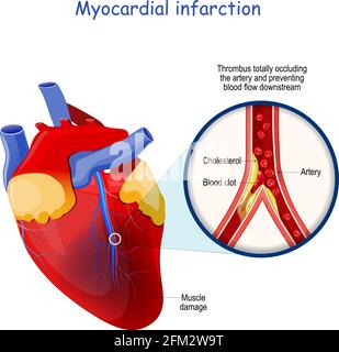 Myocardial infarction. heart attack. Thrombus totally occluding the artery and preventing blood flow downstream. Heart with Muscle damage Stock Vector