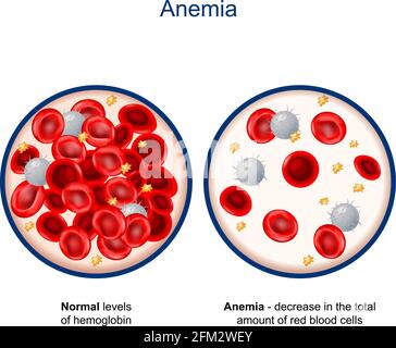 Meaning anemia anemia