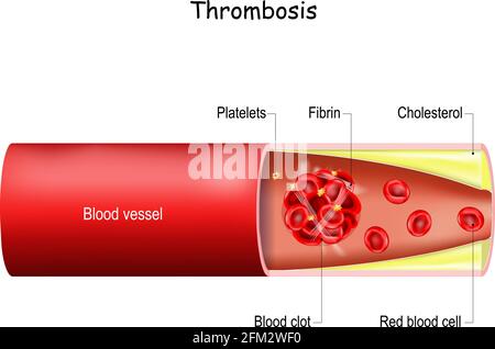Thrombosis. Blood clot in a blood vessel (artery or vein). health problem. Vector illustration for medical use. Stock Vector