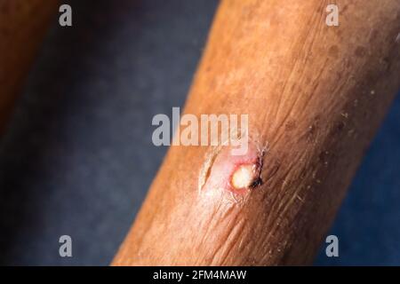A close up shot of an infected boil filled with pus inside on the leg of a patient. A painful, pus-filled bump under the skin caused by infected, infl Stock Photo