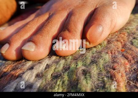 A close up shot of a water filled blister on foot due to long walks. A blister is a pocket of fluid between the upper layers of skin. Stock Photo