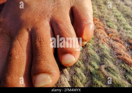 A close up shot of a water filled blister on foot due to long walks. A blister is a pocket of fluid between the upper layers of skin. Stock Photo