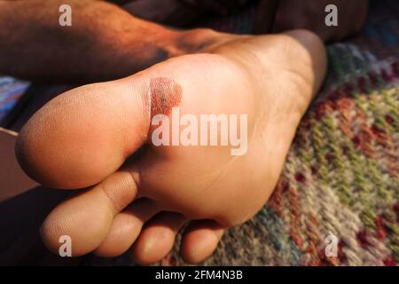 A close up shot of blister on foot due to long walks. A blister is a pocket of fluid between the upper layers of skin. Stock Photo