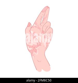 Woman hand with eczema in hand drawn style. Skin dermatitis or allergy - vector isolated art. Redness palm rash, inflammation and scaling Stock Vector