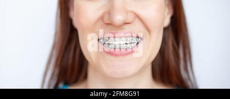 The woman smiles, showing her white teeth with braces. Even teeth from wearing braces. The concept of a dentist and an orthodontist. Stock Photo