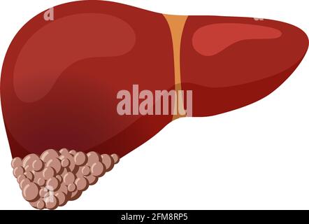 Unhealthy liver cancer. Human exocrine gland organ tumor destruction concept. Vector oncology flat illustration Stock Vector