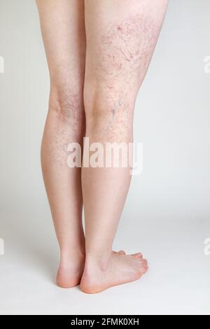 Varicose Veins on a Female Legs Stock Image - Image of care, issue