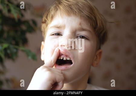 Portrait of frustrated blond boy lifting upper lip of his open mouth with finger on blurry background of wall and house plant. Tooth aches or new toot Stock Photo