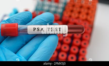 PSA test result with blood sample tube Stock Photo - Alamy