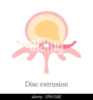 Herniated spinal - Extrusion, Full Ruptured. Vector diagram, hand drawn. Infographic of third stage hernia of intervertebral disk Stock Vector