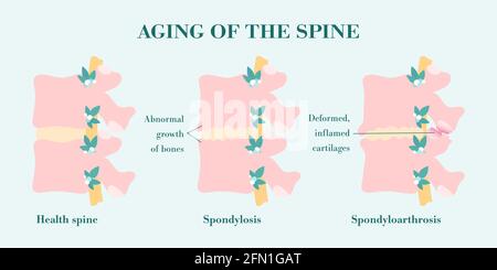 Spondylosis, bone growth of vertebral column that one of causes of the low back pain. Facet joint arthrosis, deformed and inflamed processes. Spinal d Stock Vector