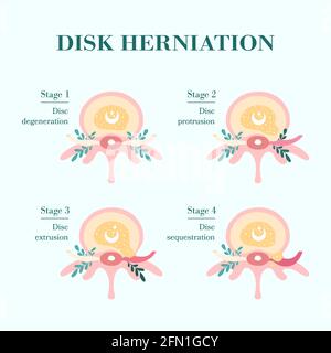 Stages of disc herniation spine and disc anatomy 3d medical vector ...