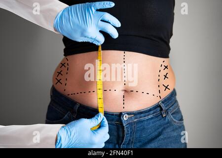 Loose Waist Care By Doctor In Clinic. Liposuction Surgery Stock Photo