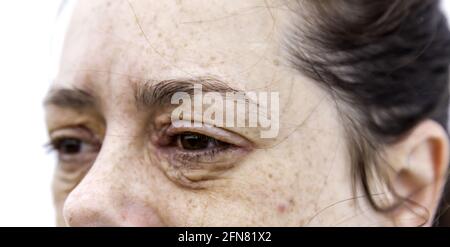 Dermatitis and allergy in eyes, dermatological disease and skin problems Stock Photo