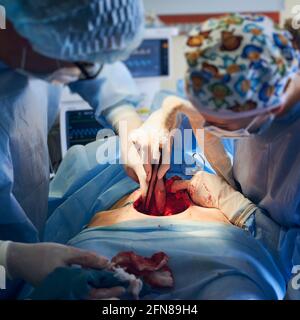 Focus on patient abdomen with wound. Doctors in sterile gloves performing plastic surgery in operating room. Surgeons using medical instruments and removing excess fat. Concept of abdominoplasty. Stock Photo