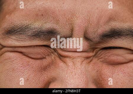 closeup ugly bad face male oily with large skin pores and pimple macro high detail. Stock Photo