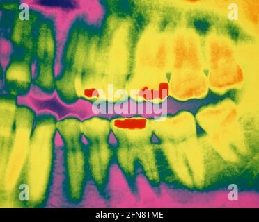 Dentistry. Diagnostic image. Teeth close up. False colour image showing fillings. Stock Photo