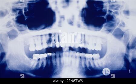 Dentistry. Diagnostic image of teeth after corrective surgery showing dental implants. Stock Photo