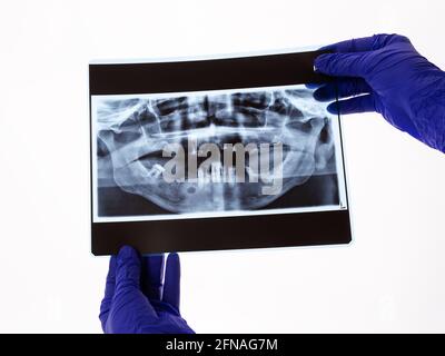 The dentist hands holding the panoramic facial x-ray image of an old person with some lower teeth and no tooth of the upper. Original x-ray teeth scan Stock Photo