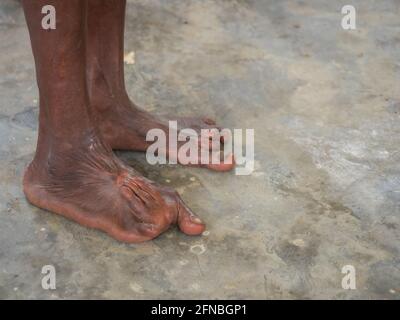 A person with leg deformities due to polio or other diseases in the middle of the Indonesian jungle Bird's Head Peninsula, West Papua, Indonesia, Asia Stock Photo