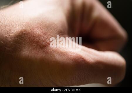 Allergic rash after contact allergy: pustules, spots, blisters and wheals on the skin as allergic reaction Stock Photo