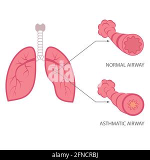 vector asthma illustration, bronchial, lungs respiratory disease Stock Vector