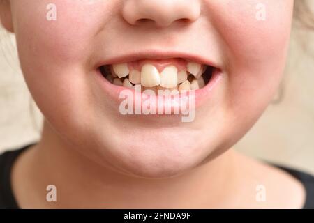 Crooked teeth in a child girl Stock Photo