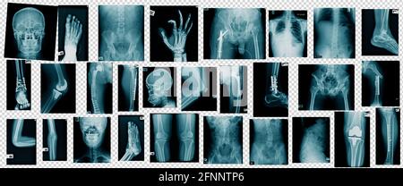 hight quality collection x-ray image in blue tone Stock Photo