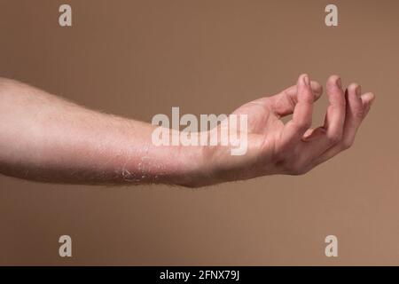 Sunburnt peeling skin on a damaged mans arm. A painful dry injured cracked part of the body healing from too much uv light without sun protection Stock Photo