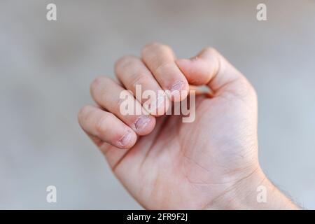 A man's hand with bitten and ugly fingernails. Bad care of hands Stock ...