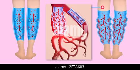 Varicose veins on a female senior legs. The structure of normal and varicose veins. Concept of old senior people, varicose veins and deep vein thrombosis or DVT. Illustration Stock Photo