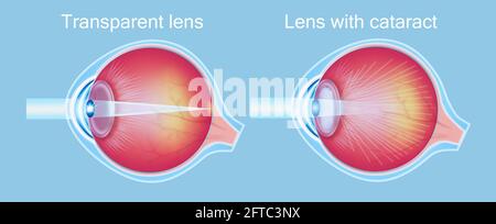 Cataract Eyes. Cataracts and healthy eye detailed structure Stock Photo