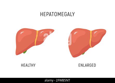 Enlarged liver hepatomegaly disease icon. Human liver health illustration anatomy design Stock Vector