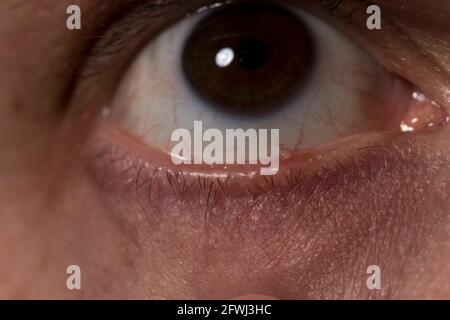 Stye infection on eye lid close up stye with pus pimple on lower eye lid. Stock Photo