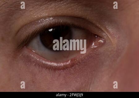 Eye stye close up eye infection pimple with pus on lower eye lid. Stock Photo