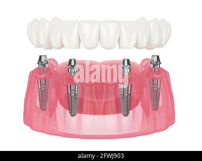 Mandibular prosthesis all on 4 system supported by over white background Stock Photo