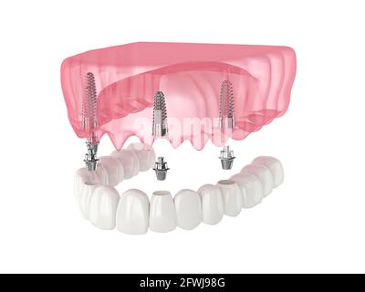 Mandibular prosthesis all on 4 system supported by over white background Stock Photo