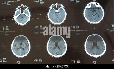 X-ray of the brain with a head injury, stroke disease in the senior chegovik. Magnetic resonance imaging, MRI close up on examination at the hospital by a doctor Stock Photo