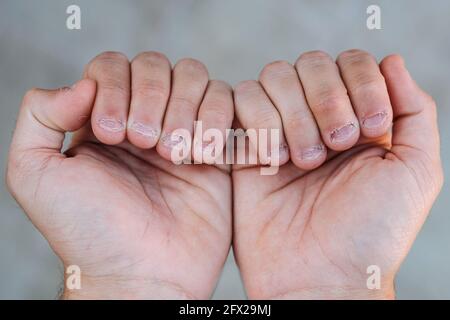 Close up detail of two hands with bitten and ugly nails Stock Photo