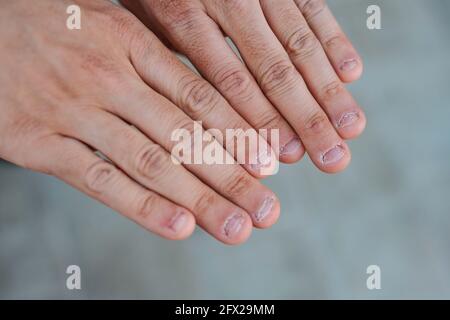 Close up detail of two hands with bitten and ugly nails Stock Photo