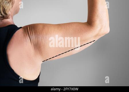 Overweight Lady Arm With Excess Fat. People Obesity Stock Photo