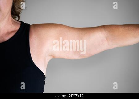 Overweight Lady Arm With Excess Fat. People Obesity Stock Photo