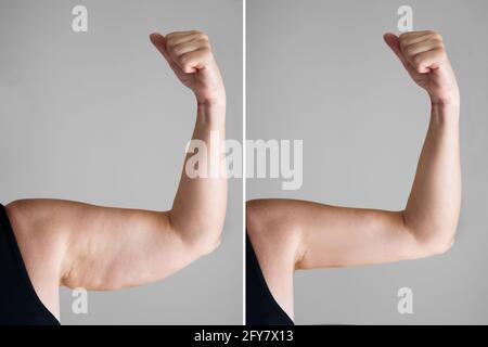 Obesity Cellulite And Fat Removal Surgery Before And After Stock Photo