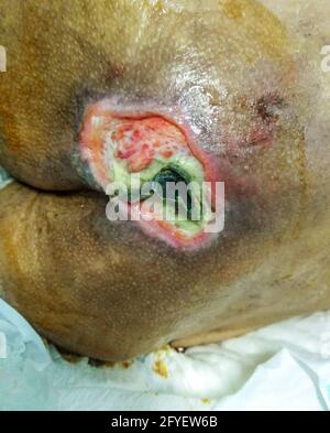 Close up infected wound of patient Bedsores ,selective focus. Stock Photo