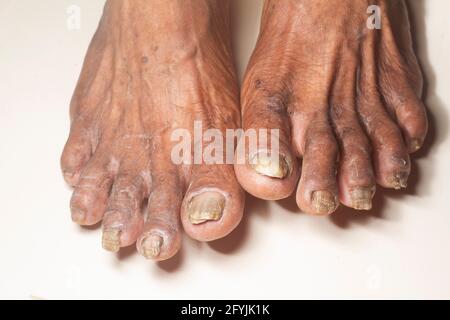 Fungus Infection on Nails of old woman's Foot Stock Photo