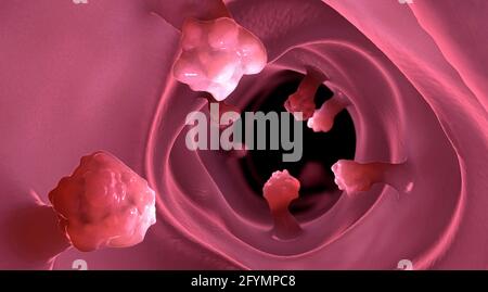 Intestinal polyps, illustration Stock Photo