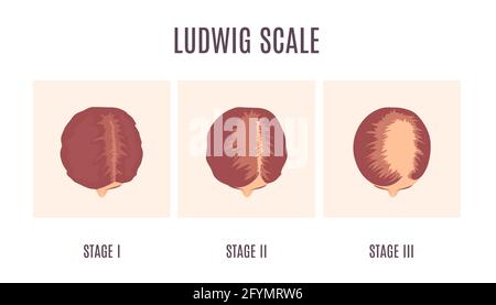 Ludwig scale of baldness in women, Stock Photo