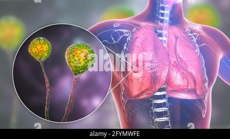 Pulmonary mucormycosis, illustration Stock Photo