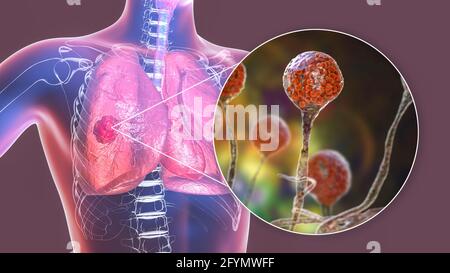 Pulmonary mucormycosis, illustration Stock Photo