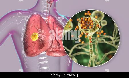 Pulmonary mucormycosis, illustration Stock Photo